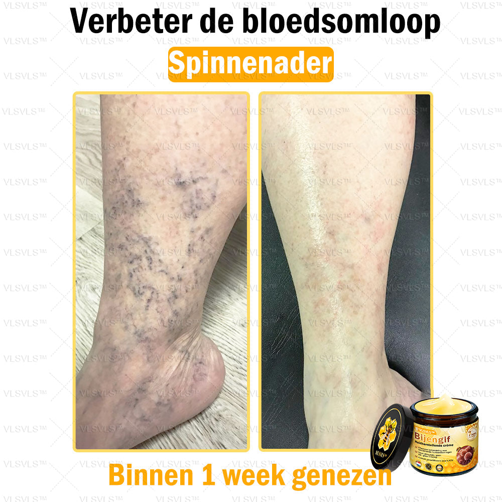 VLSVLS™ Bijengif Huidherstellende Crème (👨⚕Goedgekeurd door het NVDV)🔥