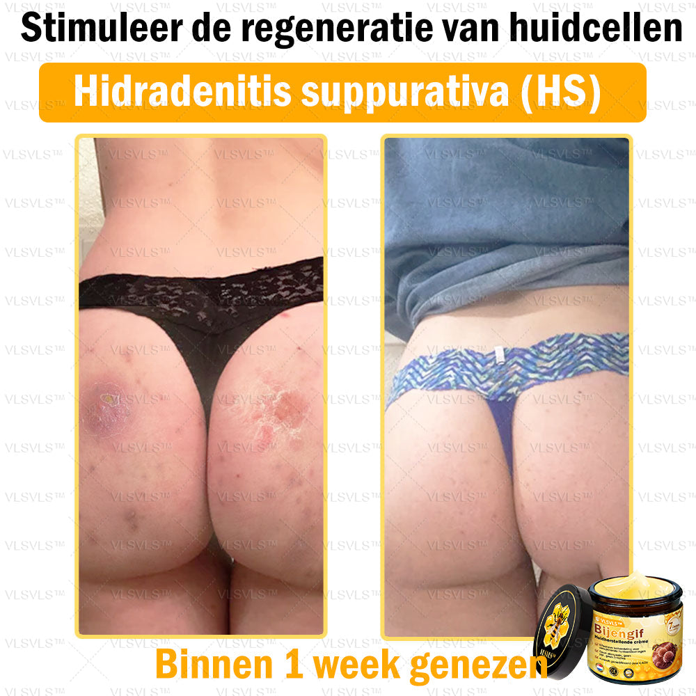 VLSVLS™ Bijengif Huidherstellende Crème (👨‍⚕‍Goedgekeurd door het NVDV)🔥