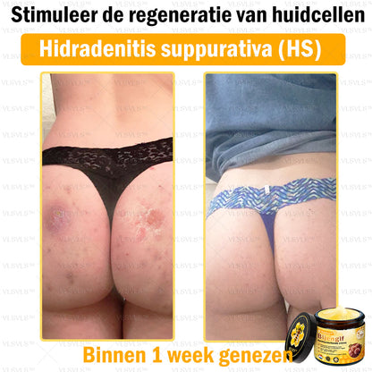 VLSVLS™ Bijengif Huidherstellende Crème (👨‍⚕‍Goedgekeurd door het NVDV)🔥