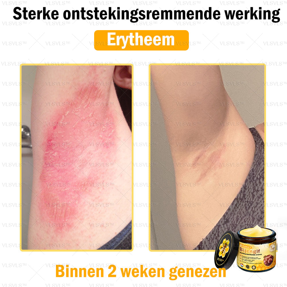 VLSVLS™ Bijengif Huidherstellende Crème (👨‍⚕‍Goedgekeurd door het NVDV)🔥