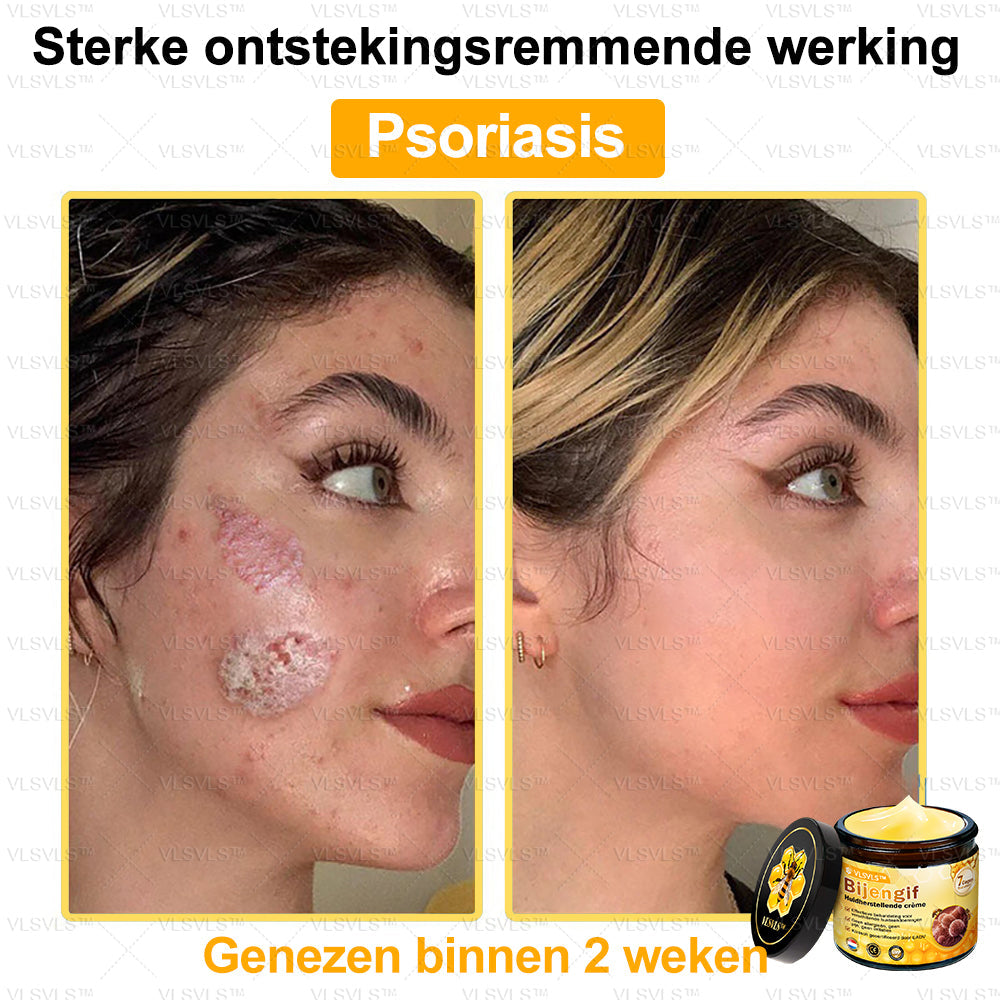 VLSVLS™ Bijengif Huidherstellende Crème (👨‍⚕‍Goedgekeurd door het NVDV)🔥