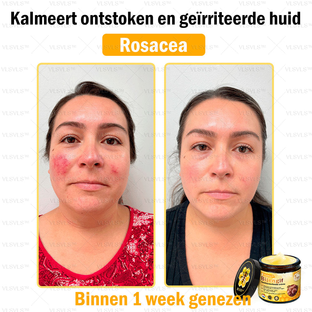 VLSVLS™ Bijengif Huidherstellende Crème (👨‍⚕‍Goedgekeurd door het NVDV)🔥