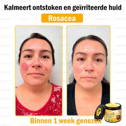 VLSVLS™ Bijengif Huidherstellende Crème (👨‍⚕‍Goedgekeurd door het NVDV)🔥