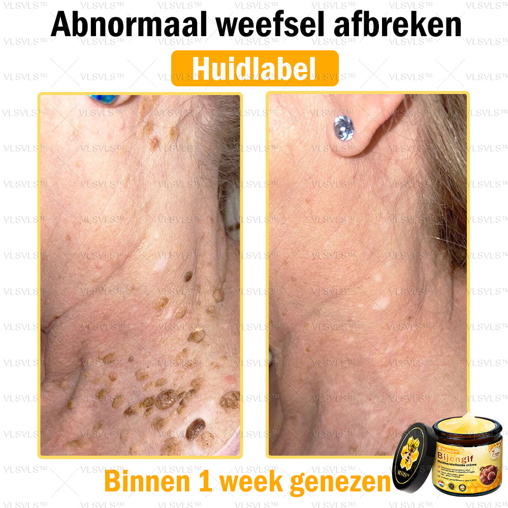 VLSVLS™ Bijengif Huidherstellende Crème (👨‍⚕‍Goedgekeurd door het NVDV)🔥