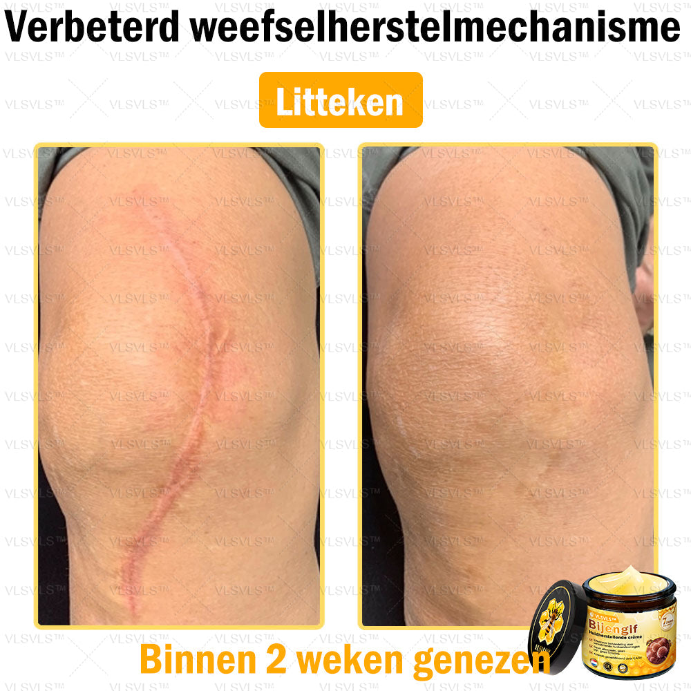 VLSVLS™ Bijengif Huidherstellende Crème (👨‍⚕‍Goedgekeurd door het NVDV)🔥